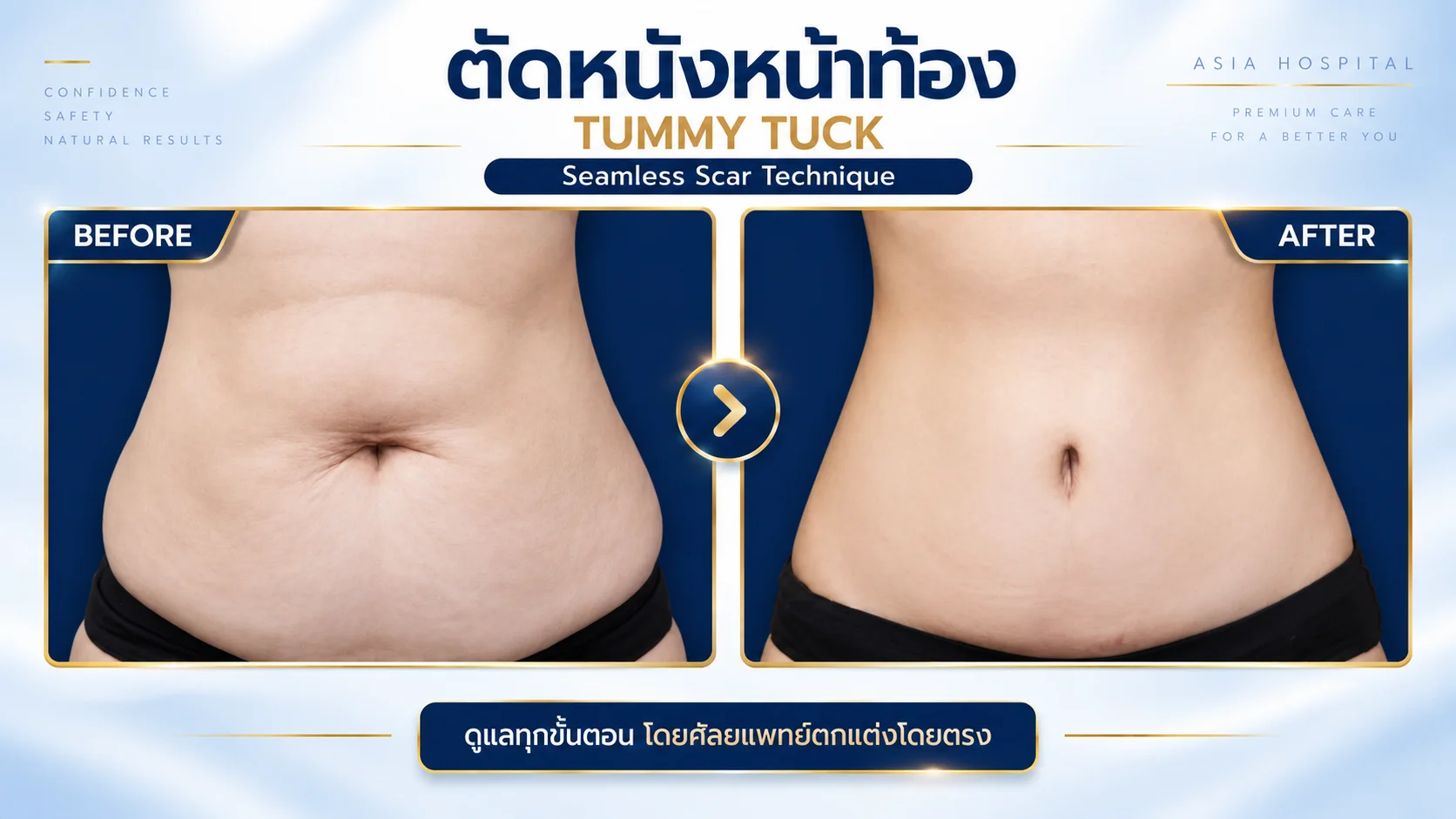 รีวิวตัดหนังหน้าท้อง-ตกแต่งสะดือ