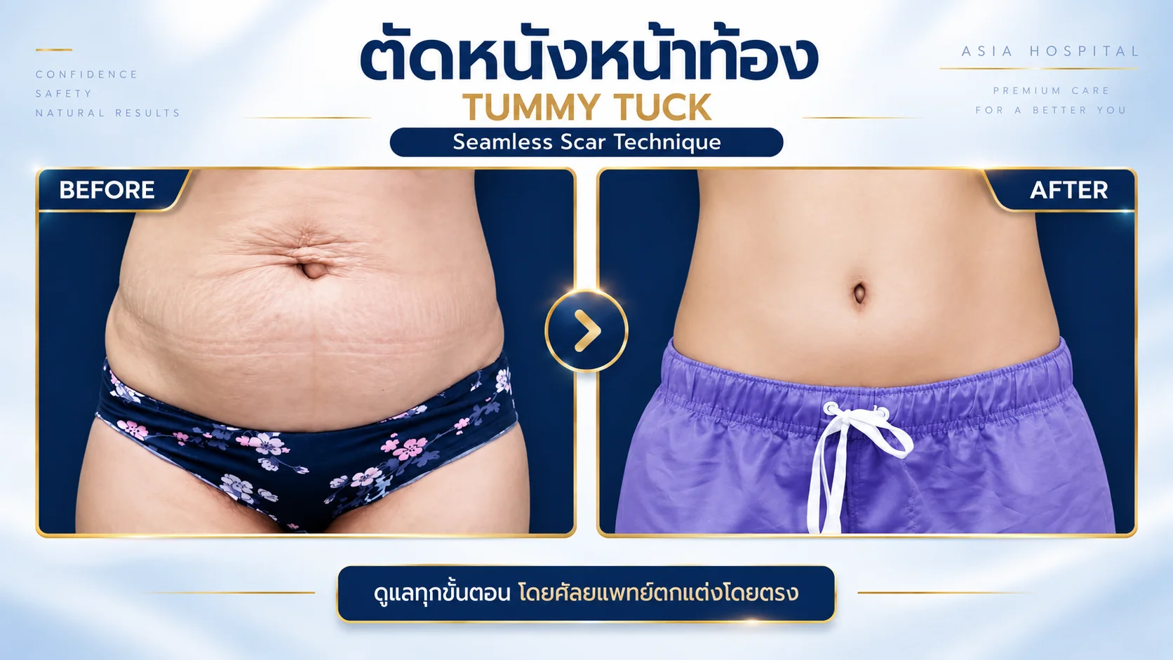รีวิวตัดหนังหน้าท้อง-ย้ายสะดือ