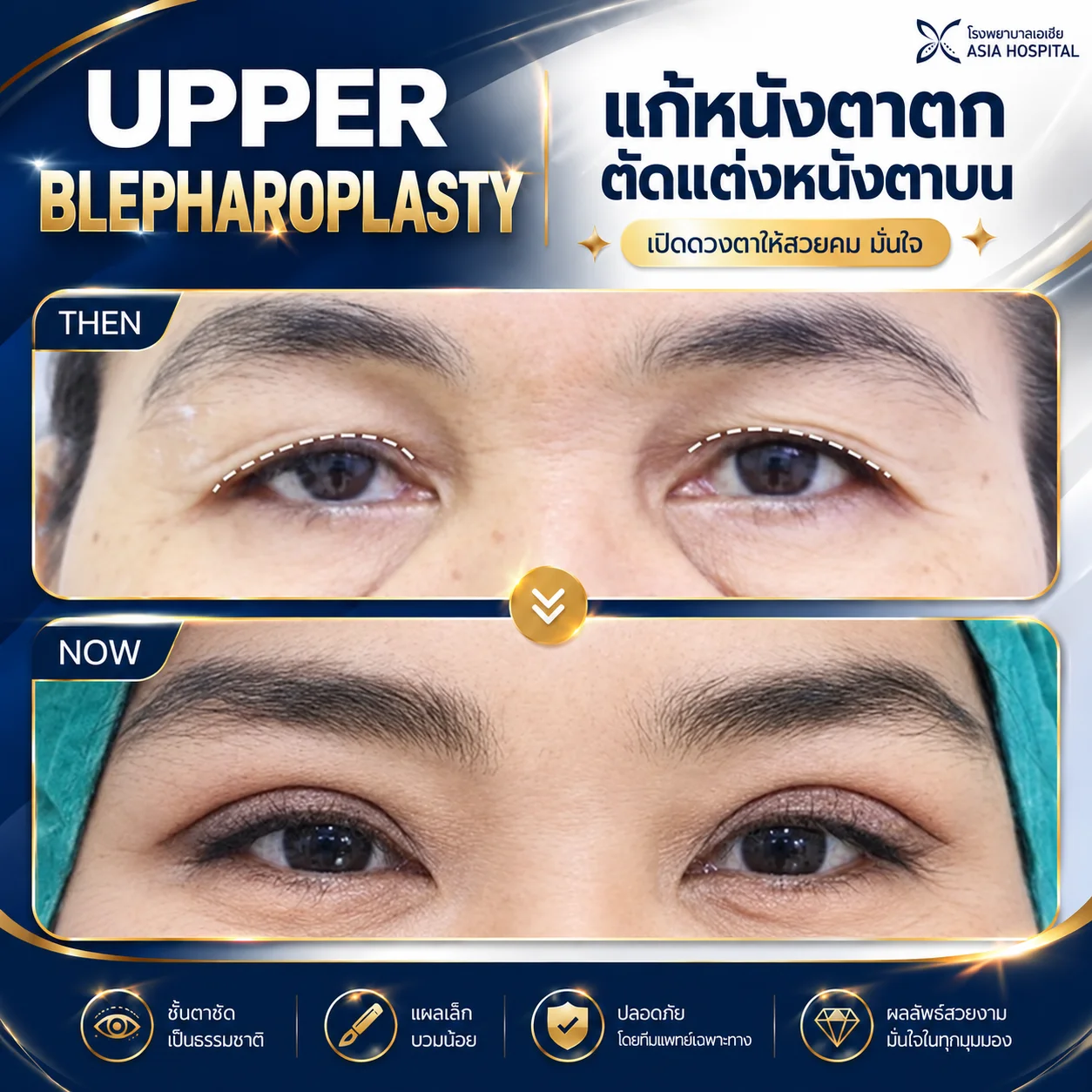 รีวิวแก้หนังตาตก ตัดหนังตาบน | โรงพยาบาลเอเซีย | โรงพยาบาลเอเซีย รีวิวตัดหนังตาบน-แก้หนังตาตก