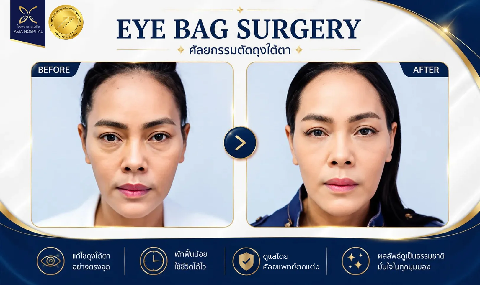 ตัดถุงใต้ตาที่ไหนดี