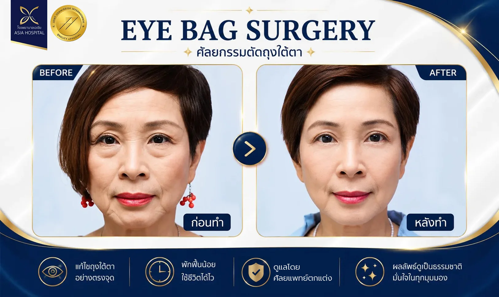 รีวิวตัดถุงใต้ตา_จัดเรียงไขมันใต้ตา