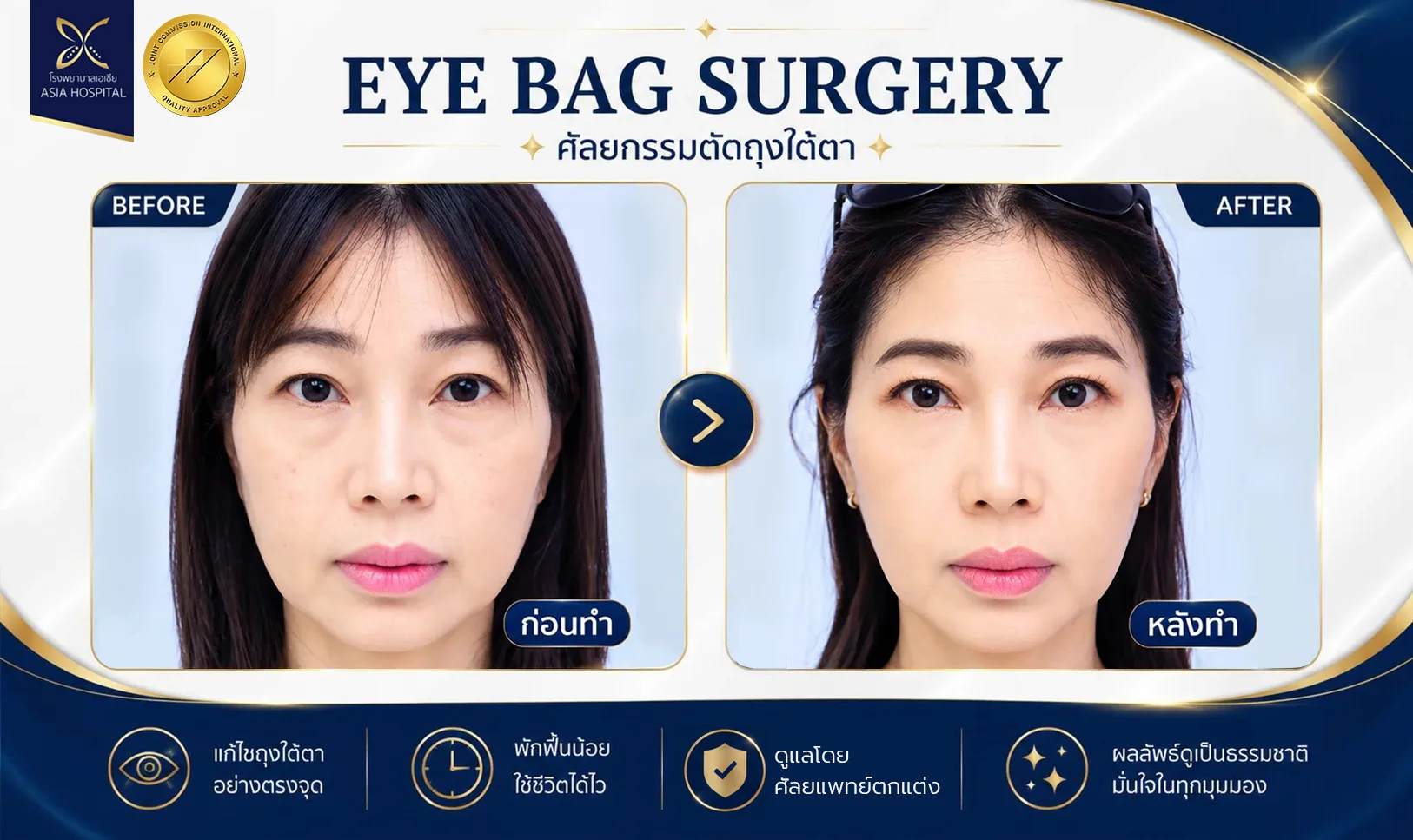 รีวิวตัดถุงใต้ตา_ตัดถุงใต้ตาที่ไหนดี