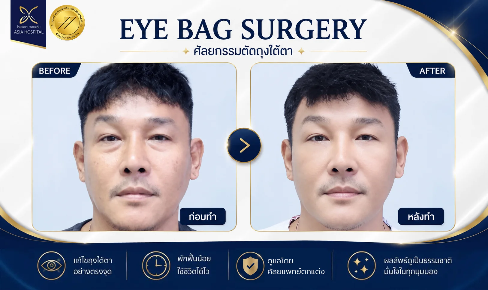 รีวิวตัดถุงใต้ตา_ตัดถุงใต้ตาผู้ชาย