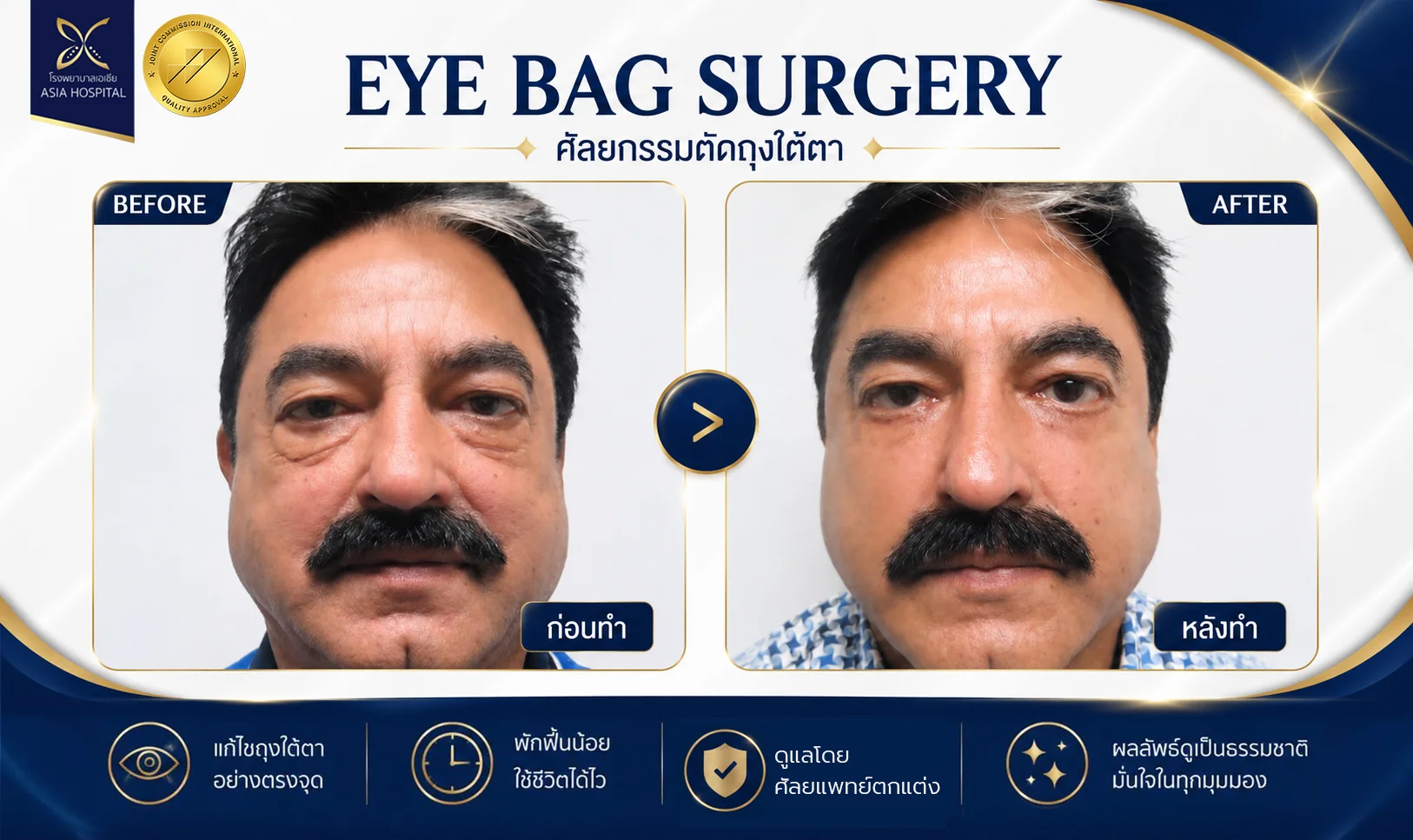 รีวิวตัดถุงใต้ตา_ตัดถุงใต้ตาผู้ชาย