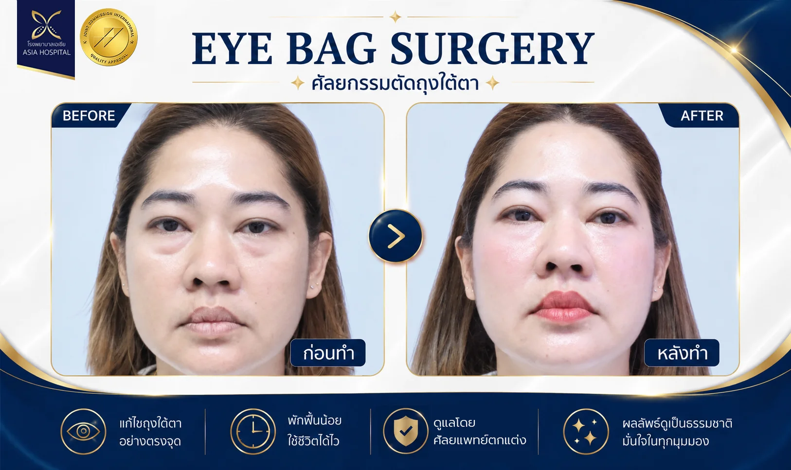 ตัดถุงใต้ตาราคา