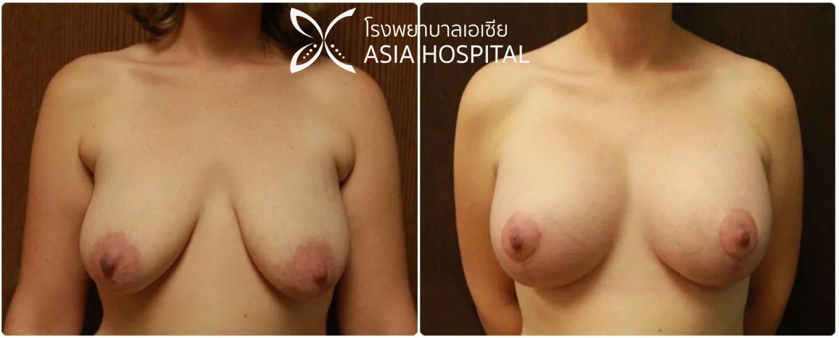 ยกกระชับหน้าอก-รีวิวยกกระชับหน้าอก