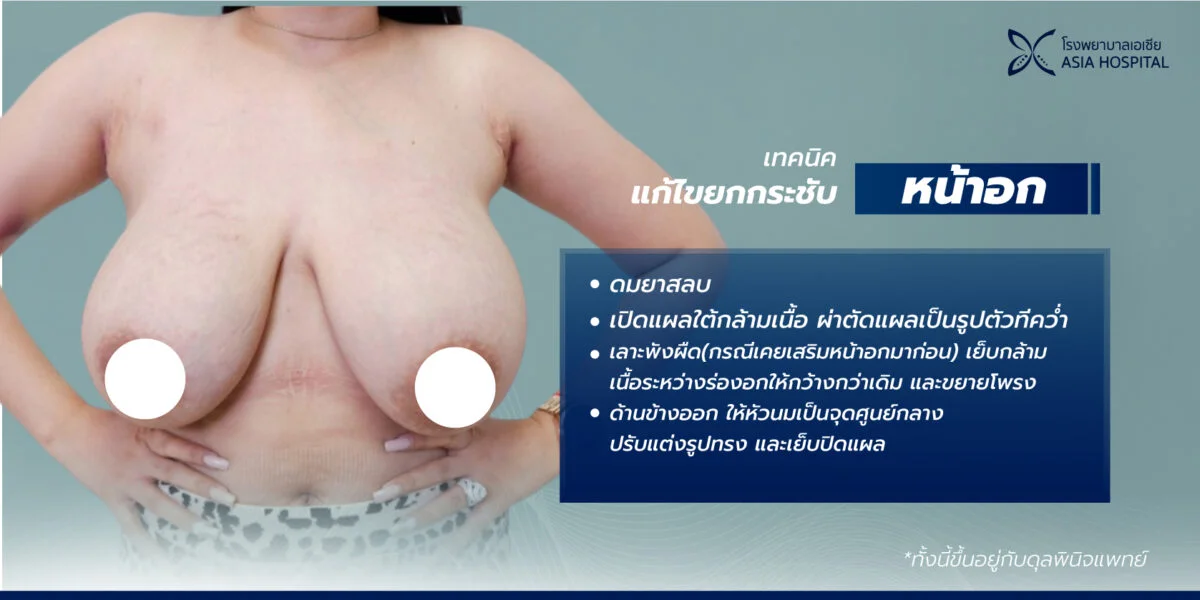 ยกกระชับหน้าอก-breast-lift