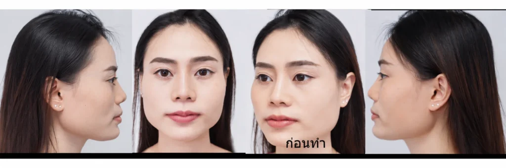 ก่อนทำ ยุบโหนก ตัดกราม กรอกราม แก้ไขคางเล็ก