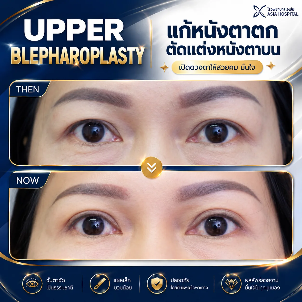 รีวิวตัดหนังตาบน-แก้หนังตาตก | โรงพยาบาลเอเซีย | โรงพยาบาลเอเซีย รีวิวตัดหนังตาบน-แก้หนังตาตก