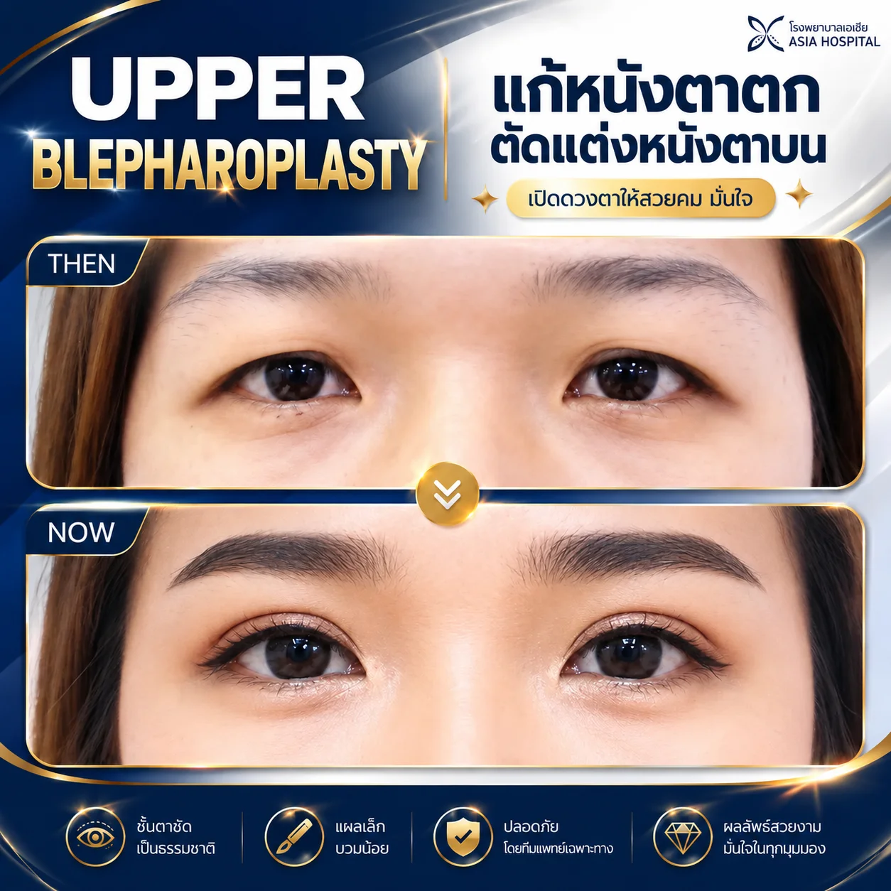 รีวิวตัดหนังตาบน-แก้ไขหนังตาตก | โรงพยาบาลเอเซีย | โรงพยาบาลเอเซีย รีวิวแก้หนังตาตก-ตัดหนังตาบน