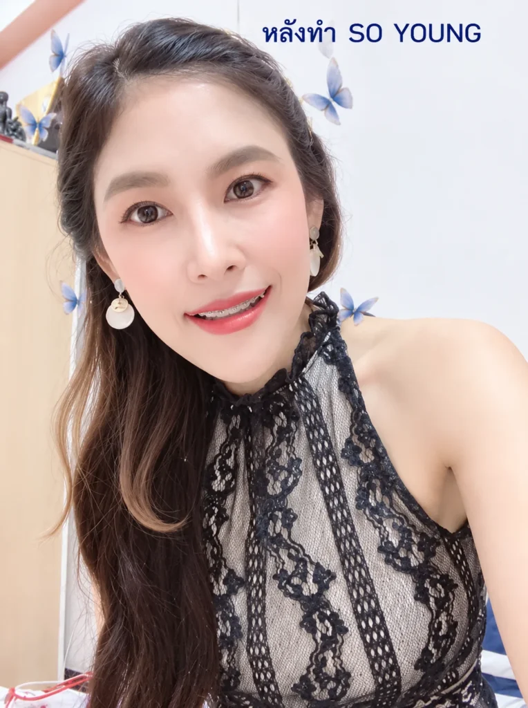 หลังปรับโครงหน้า-ยุบโหนกตัดกราม