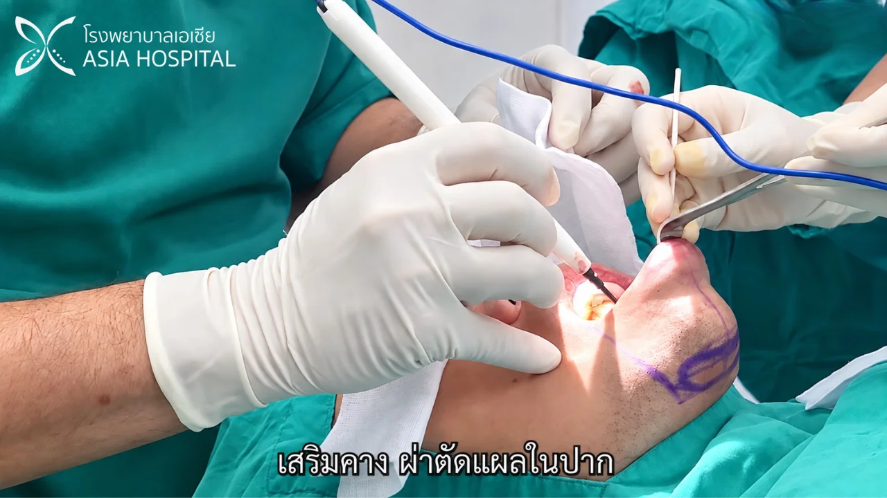 แพทย์ผ่าตัดเสริมคาง เทคนิคแผลในปาก