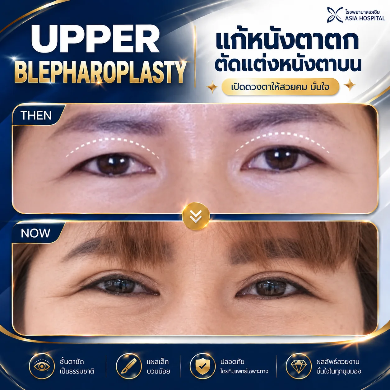 แก้หนังตาตก-รีวิวตัดหนังตาบน | โรงพยาบาลเอเซีย | โรงพยาบาลเอเซีย รีวิวตัดหนังตาบน-แก้หนังตาตก