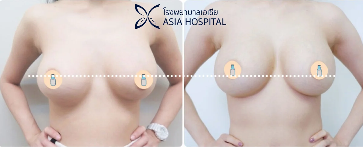 แก้หน้าอก รีวิวแก้หน้าอก | โรงพยาบาลเอเซีย | โรงพยาบาลเอเซีย แก้หน้าอก-นมห่าง-รีวิวแก้หน้าอก