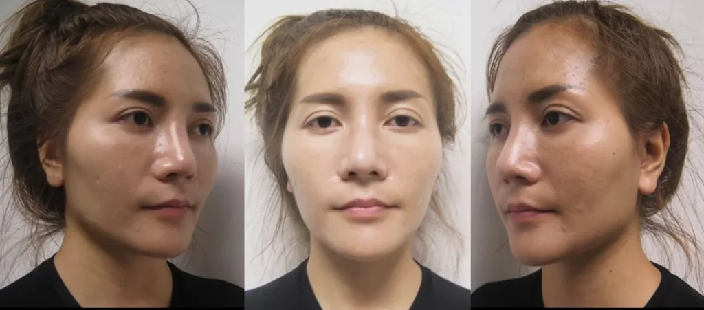 ก่อนยุบโหนกแก้ม-ตัดกราม-มีปัญหาโหนกแก้มสูง